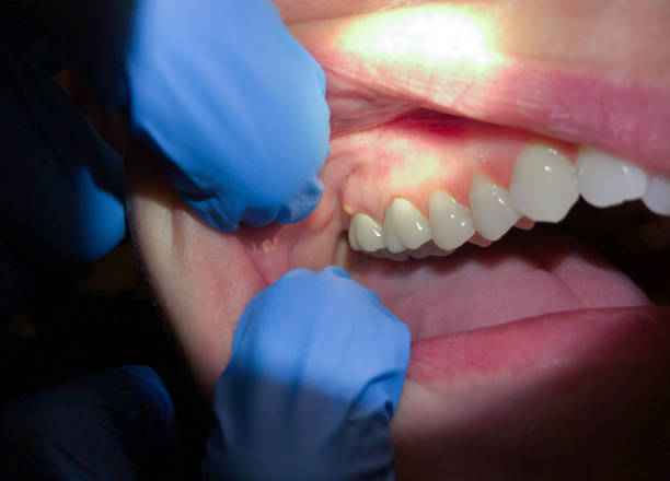 Best Broken or Cracked Tooth Emergency Dentist in Danville, CA