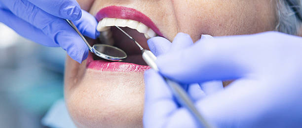 Best Emergency Dentist for Lost Fillings or Crowns in Danville, CA